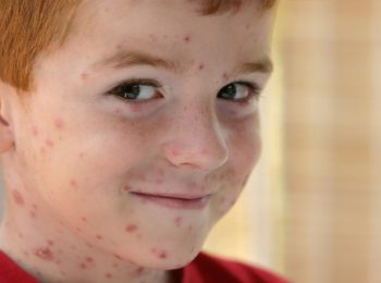 Si può andare in spiaggia con la varicella?