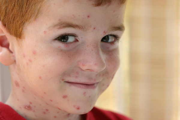 Si può andare in spiaggia con la varicella?