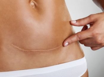 Troppi parti cesarei in Italia, le Regioni corrono ai ripari