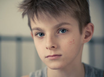 Le cicatrici dei bambini: come trattarle e accettarle