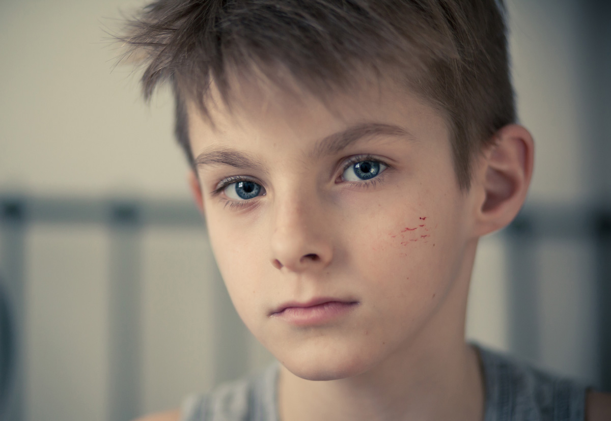 Le cicatrici dei bambini: come trattarle e accettarle