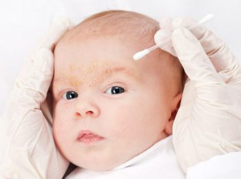 La crosta lattea del neonato: cos’è e come trattarla