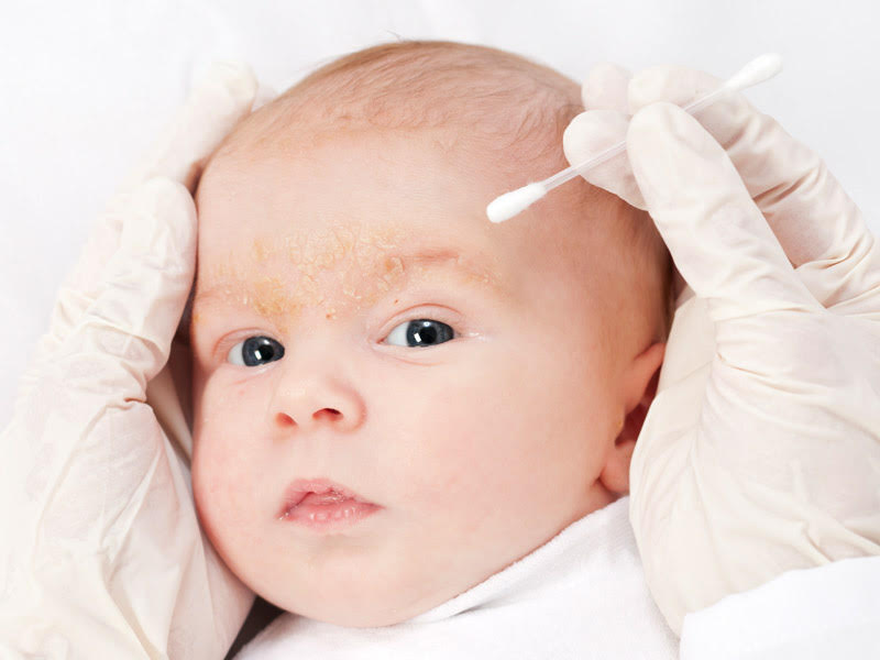 La crosta lattea del neonato: cos’è e come trattarla